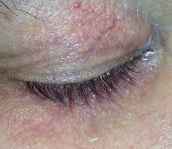 Мікроскопія-на-demodex-лабораторія-дослідження-шкірвендиспансер-Вінниця-3-зони