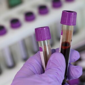 Аналіз; гепатит С; кров; ІФА, анти-HCV сумарні антитіла. Забір крові для лабораторних досліджень.